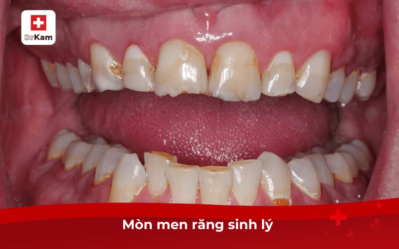 Bị ê buốt răng là bệnh gì? Nguyên nhân và cách phòng ngừa 7 Mòn men răng sinh lý