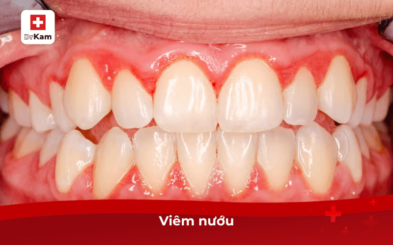 Bị ê buốt răng là bệnh gì? Nguyên nhân và cách phòng ngừa 8 Viêm nướu