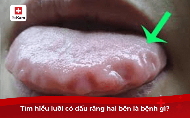 Tình trạng lưỡi có dấu răng hai bên là bệnh gì? 6 Tìm hiểu lưỡi có dấu răng hai bên là bệnh gì?