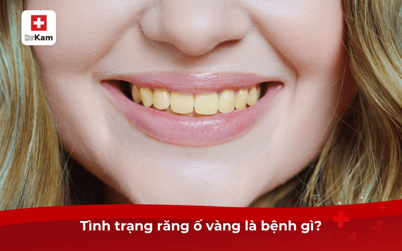 Tình trạng răng ố vàng là bệnh gì?