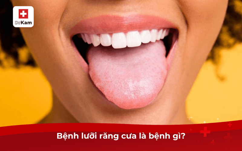 Bệnh lưỡi răng cưa là bệnh gì?