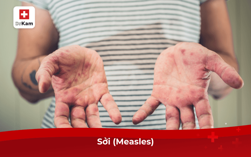 Tổng hợp các bệnh truyền nhiễm lây qua đường hô hấp 9 Sởi (Measles)