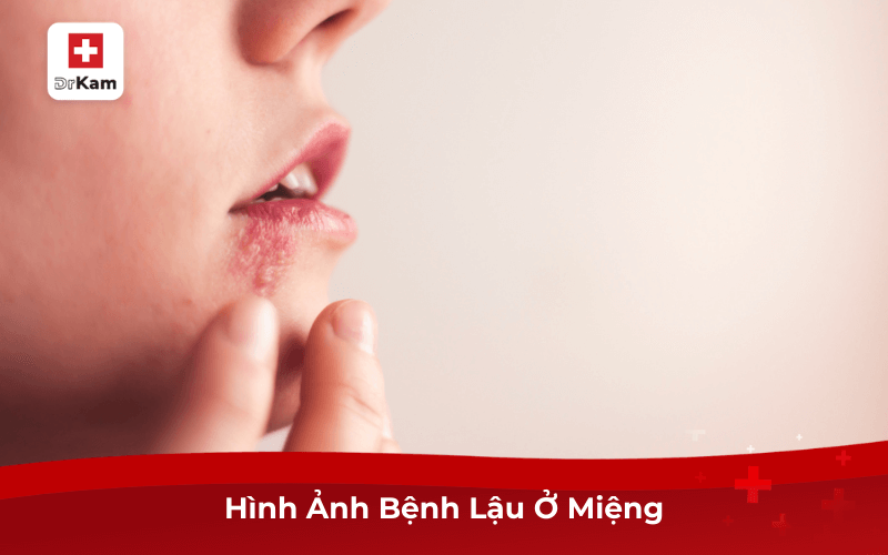 Dấu Hiệu Nhận Biết Sớm Bệnh Lậu Ở Miệng Và Điều Trị 8 Hình Ảnh Bệnh Lậu Ở Miệng