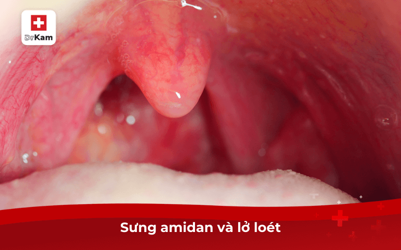 Dấu Hiệu Nhận Biết Sớm Bệnh Lậu Ở Miệng Và Điều Trị 7 Sưng amidan và lở loét