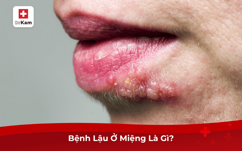 Dấu Hiệu Nhận Biết Sớm Bệnh Lậu Ở Miệng Và Điều Trị 6 Bệnh Lậu Ở Miệng Là Gì?