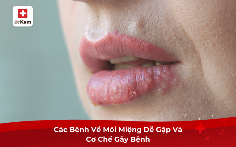 Các Bệnh Về Môi Miệng Dễ Gặp Và Cơ Chế Gây Bệnh