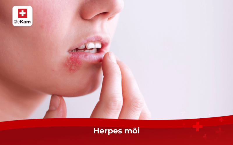 Herpes môi