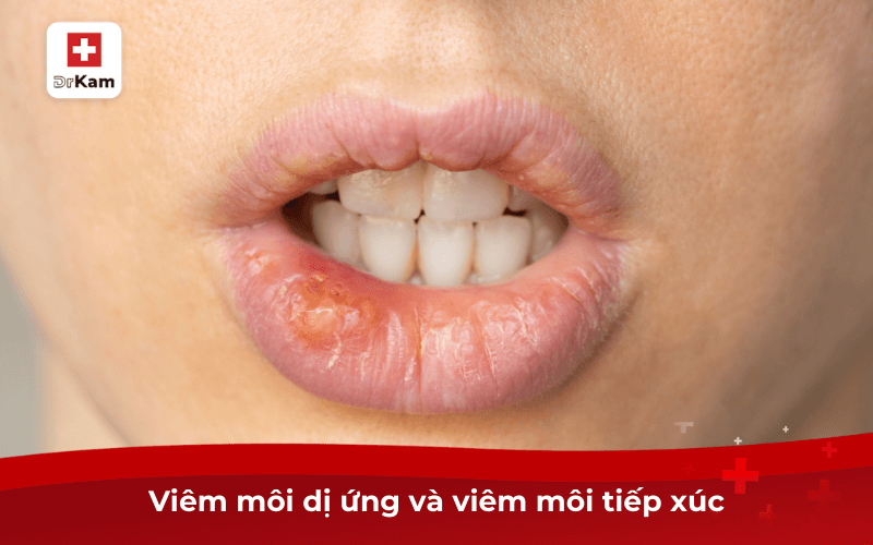 Viêm môi dị ứng và viêm môi tiếp xúc