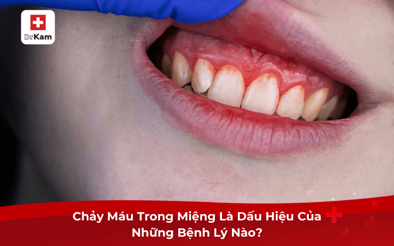 Tình Trạng Chảy Máu Trong Miệng Là Bệnh Gì? Nguyên Nhân 6 Chảy Máu Trong Miệng Là Dấu Hiệu Của Những Bệnh Lý Nào?