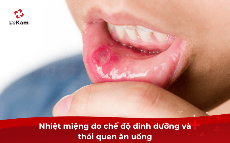 Nhiệt miệng do đâu? 6 yếu tố gây nên và cách phòng ngừa hiệu quả 4 Nhiệt miệng do đâu?
