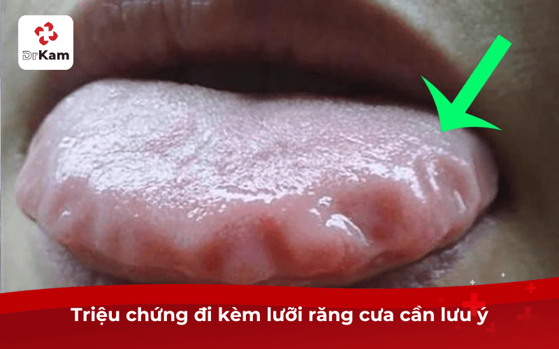 Triệu chứng đi kèm lưỡi răng cưa cần lưu ý