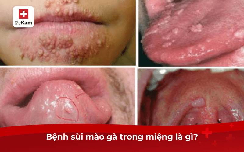 Bệnh sùi mào gà trong miệng là gì?