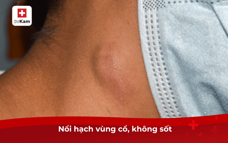 Nổi hạch vùng cổ, không sốt