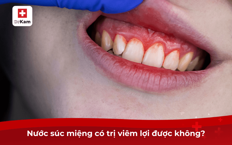 Nước súc miệng có trị viêm lợi được không?