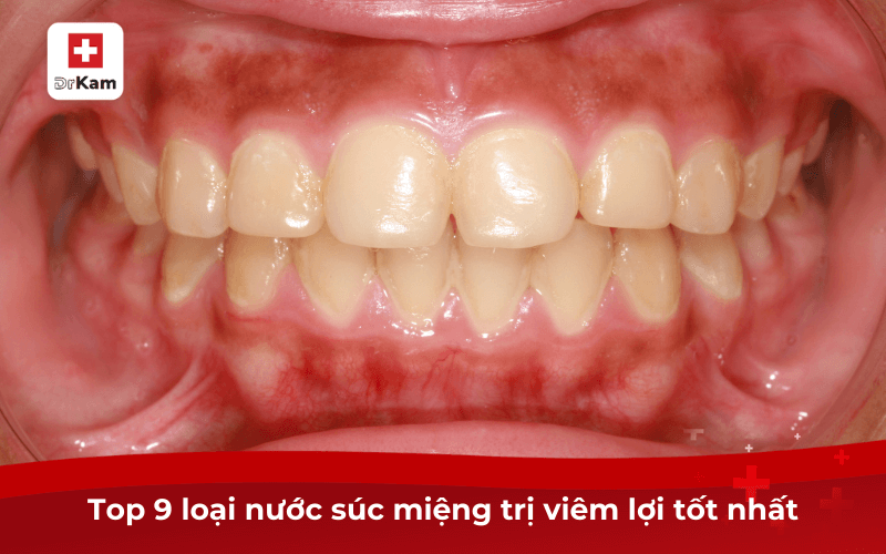Top 9 loại nước súc miệng trị viêm lợi tốt nhất