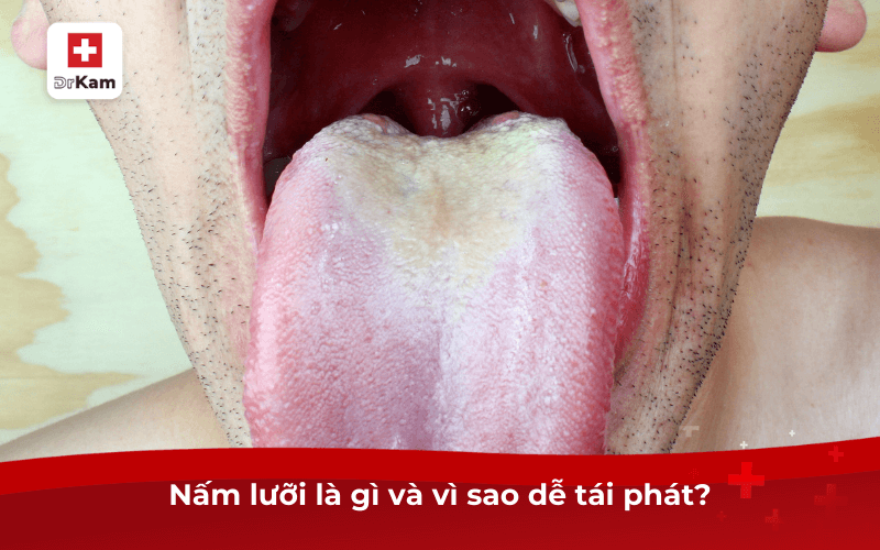 Nấm lưỡi là gì và vì sao dễ tái phát?