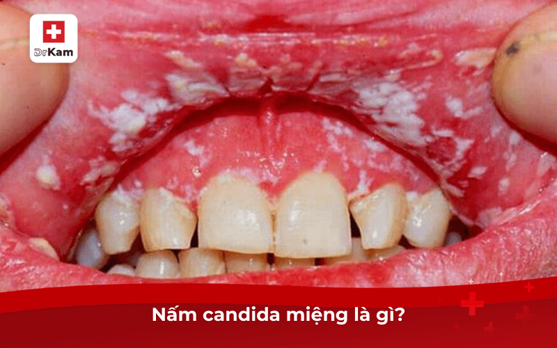 Nấm candida miệng là gì?