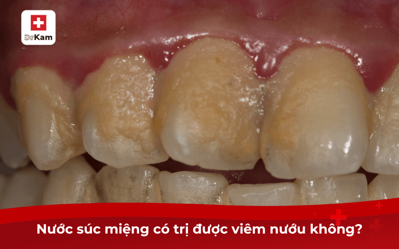Top 7 nước súc miệng trị viêm nướu hiệu quả nhất hiện nay 6 Nước súc miệng có trị được viêm nướu không?
