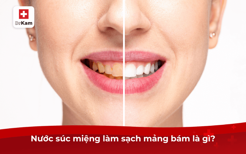 TOP 6 nước súc miệng sạch mảng bám hiệu quả 5 Nước súc miệng làm sạch mảng bám là gì?