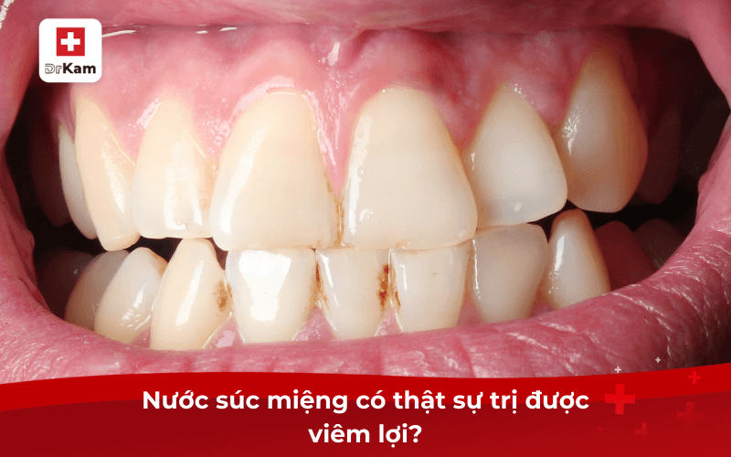 Nước súc miệng có thật sự trị được viêm lợi?