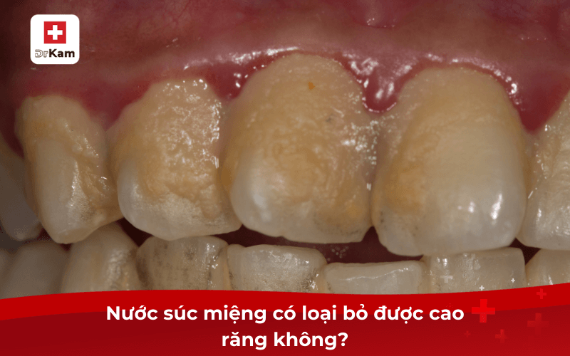 Nước súc miệng loại bỏ cao răng có thật sự hiệu quả? 6 Nước súc miệng có loại bỏ được cao răng không?