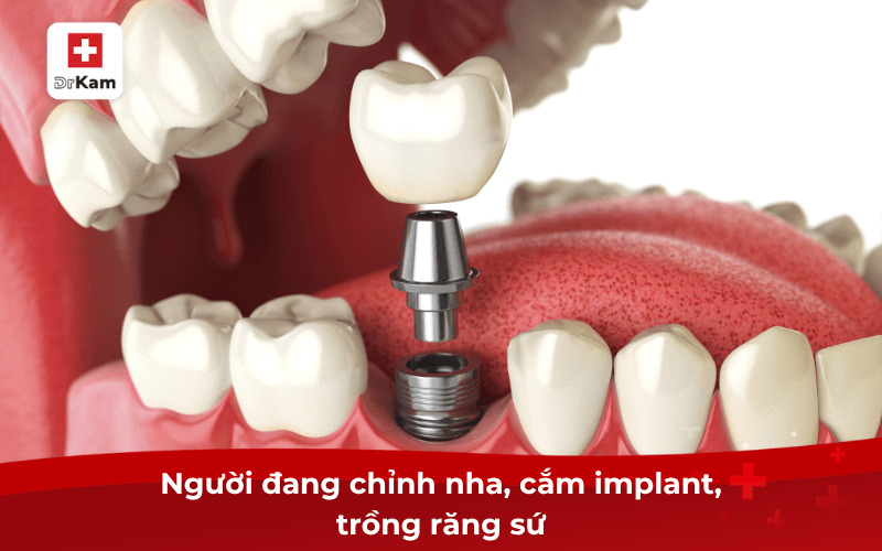 Nước súc miệng DrKam Postbiotic: Xu hướng mới của thời đại 9 Người đang chỉnh nha, cắm implant, trồng răng sứ
