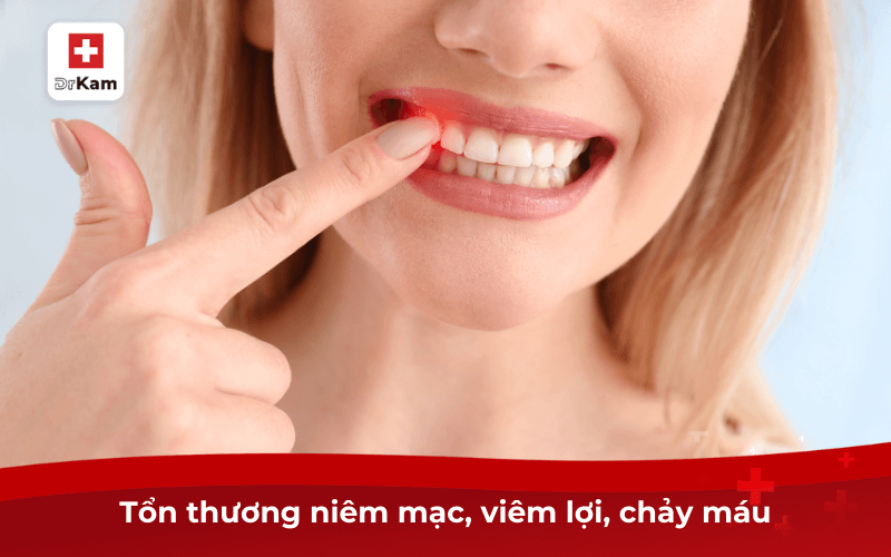 Tổn thương niêm mạc, viêm lợi, chảy máu