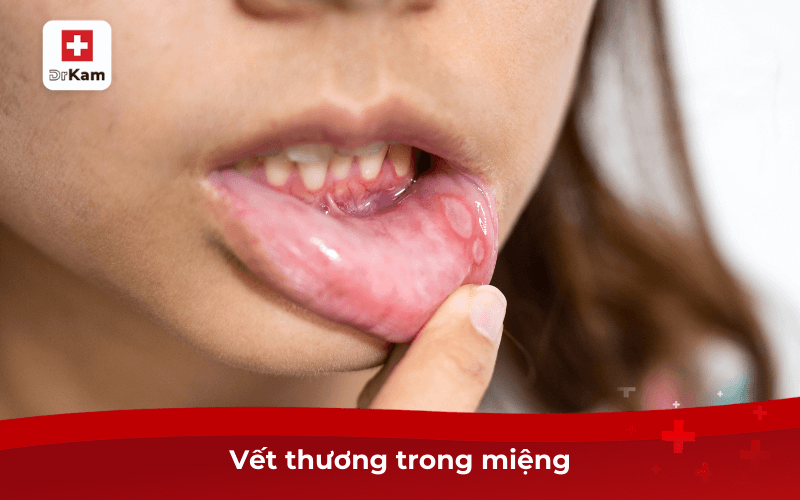 Vết thương trong miệng
