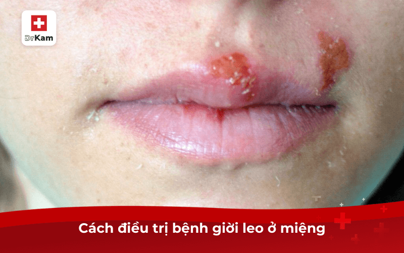 Cách điều trị bệnh giời leo ở miệng