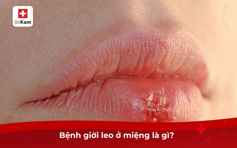Bệnh giời leo ở miệng là gì?
