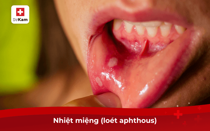 Các bệnh về miệng lưỡi nguy hiểm thường gặp hiện nay 8 Nhiệt miệng (loét aphthous)