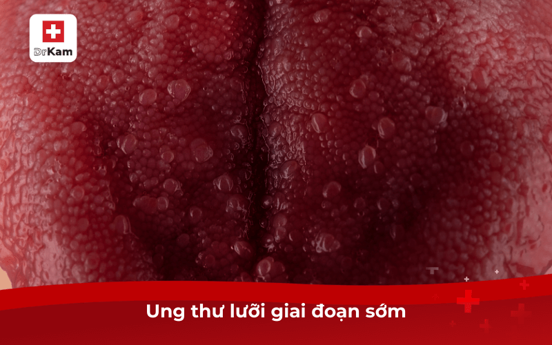 Các bệnh về miệng lưỡi nguy hiểm thường gặp hiện nay 9 Ung thư lưỡi giai đoạn sớm