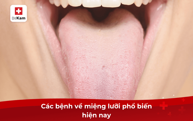 Các bệnh về miệng lưỡi nguy hiểm thường gặp hiện nay 6 Các bệnh về miệng lưỡi phổ biến hiện nay