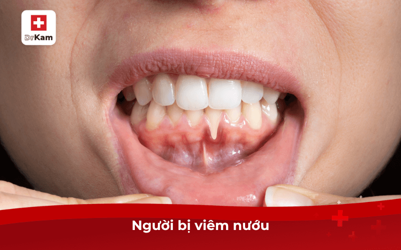 Người bị viêm nướu