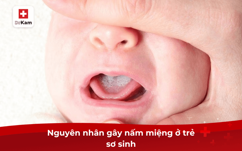 Nguyên nhân gây nấm miệng ở trẻ sơ sinh