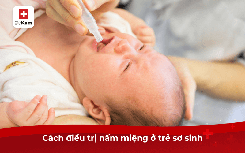 Cách điều trị nấm miệng ở trẻ sơ sinh