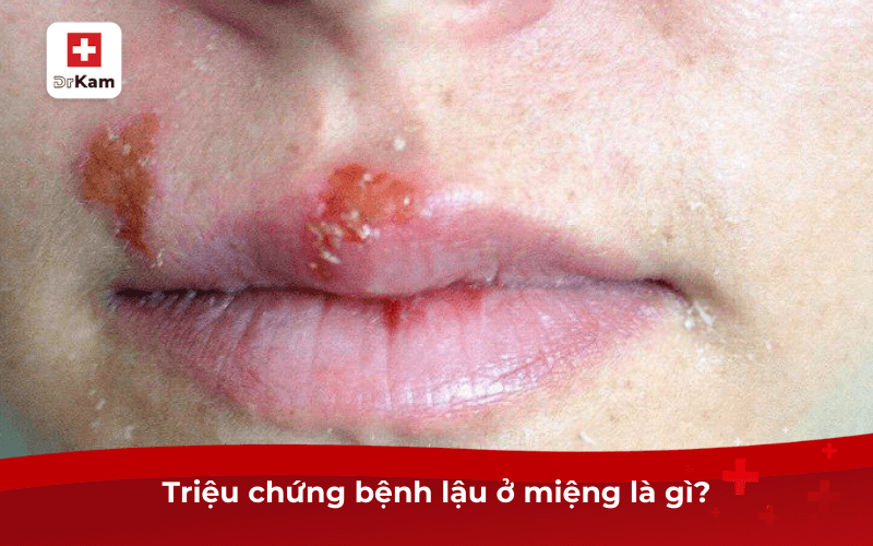 Triệu chứng bệnh lậu ở miệng và cách điều trị 6 Triệu chứng bệnh lậu ở miệng là gì?