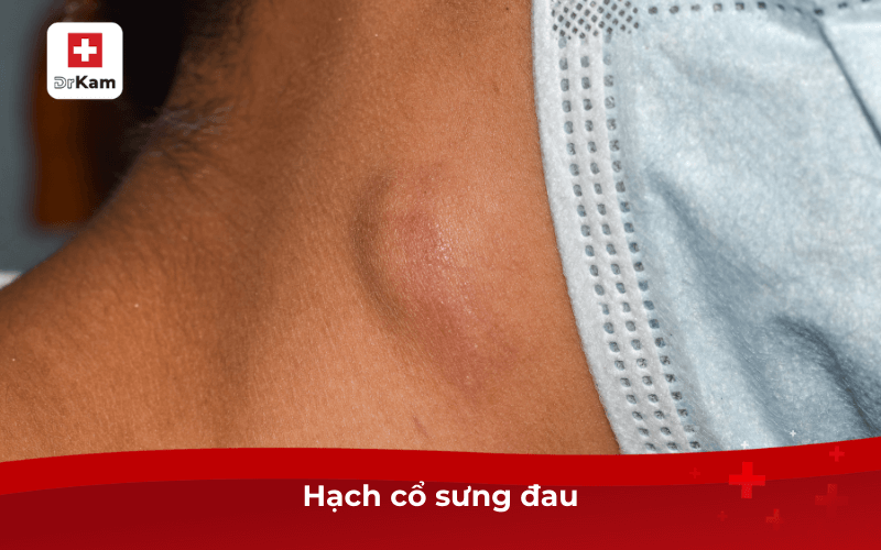 Triệu chứng bệnh lậu ở miệng và cách điều trị 7 Hạch cổ sưng đau