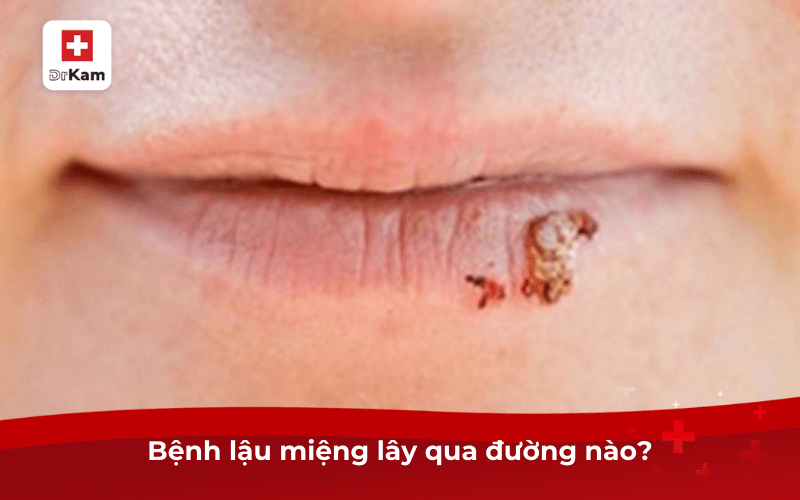 Triệu chứng bệnh lậu ở miệng và cách điều trị 8 Bệnh lậu miệng lây qua đường nào?