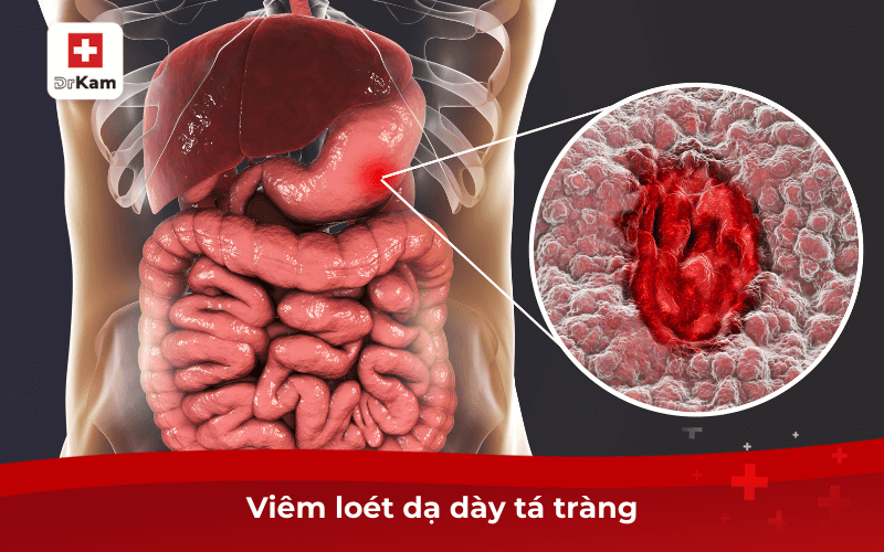 Cảm giác bụng đói nhưng miệng không muốn ăn là bệnh gì? 7 Viêm loét dạ dày tá tràng