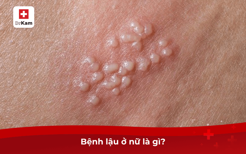 Triệu chứng vùng miệng dấu hiệu bệnh lậu ở nữ là gì? 6 Bệnh lậu ở nữ là gì?