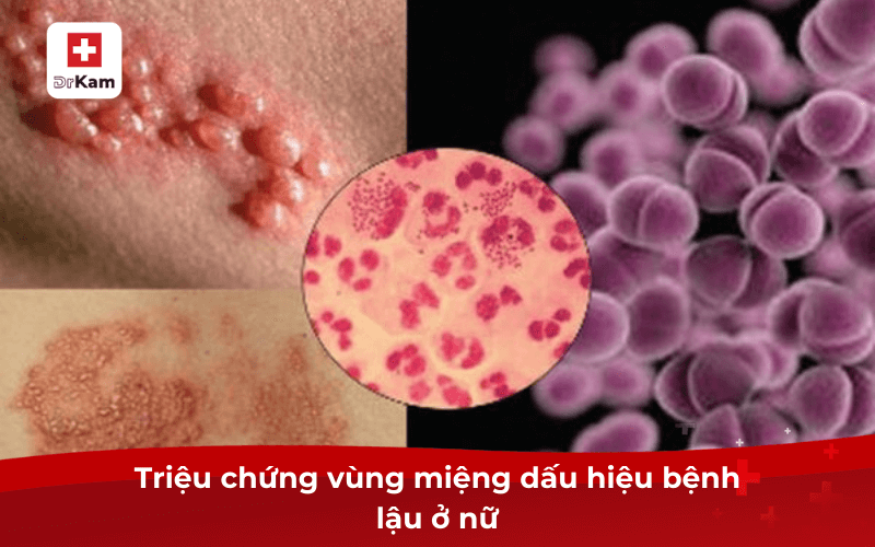 Triệu chứng vùng miệng dấu hiệu bệnh lậu ở nữ là gì? 7 Triệu chứng vùng miệng dấu hiệu bệnh lậu ở nữ