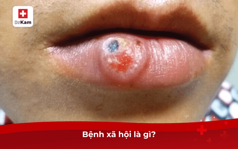 Dấu hiệu bệnh xã hội ở miệng và cách điều trị hiệu quả 6 Bệnh xã hội là gì?
