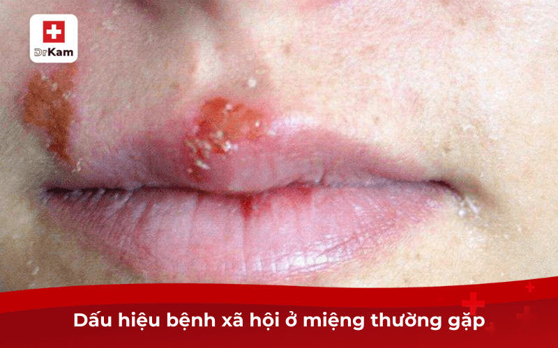 Dấu hiệu bệnh xã hội ở miệng và cách điều trị hiệu quả 7 Dấu hiệu bệnh xã hội ở miệng thường gặp