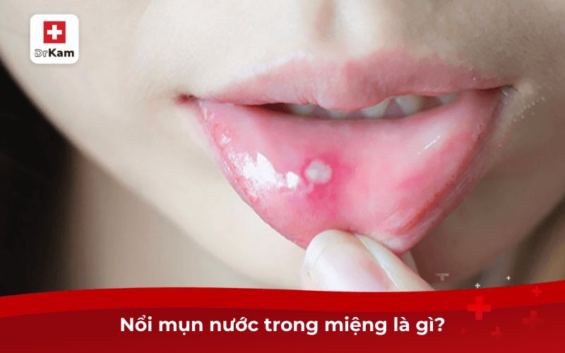 Hiện tượng nổi mụn nước trong miệng là bệnh gì? 6 Nổi mụn nước trong miệng là gì?