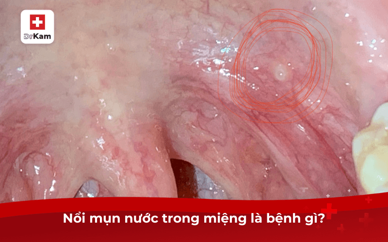 Hiện tượng nổi mụn nước trong miệng là bệnh gì? 7 Nổi mụn nước trong miệng là bệnh gì?