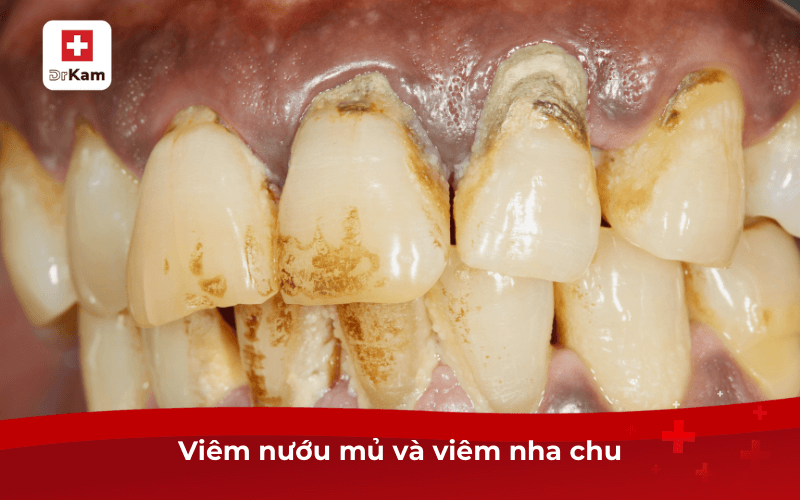 Hiện tượng nổi mụn nước trong miệng là bệnh gì? 8 Viêm nướu mủ và viêm nha chu