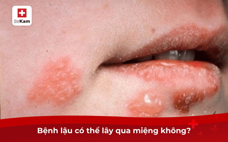 Các triệu chứng bệnh lậu ở miệng và cách điều trị 6 Bệnh lậu có thể lây qua miệng không?
