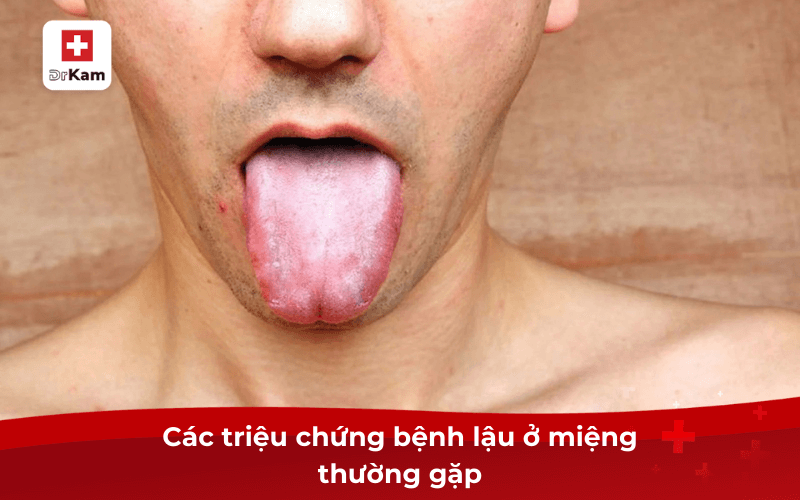 Các triệu chứng bệnh lậu ở miệng và cách điều trị 7 Các triệu chứng bệnh lậu ở miệng thường gặp