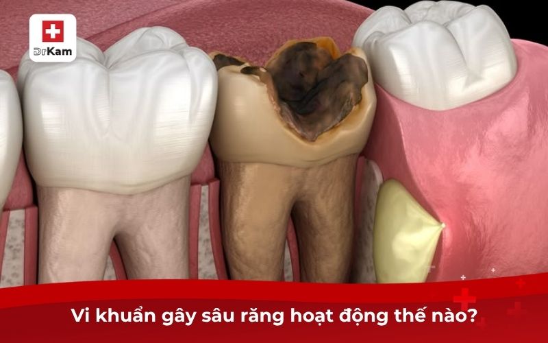Postbiotic Ngừa Sâu Răng – Giải Pháp Lợi Khuẩn Răng Miệng 7 Vi khuẩn gây sâu răng hoạt động thế nào?